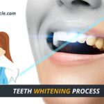 What is Teeth Whitening Process